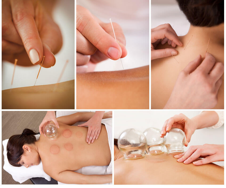Acupuncture and cupping treatments in Airdrie