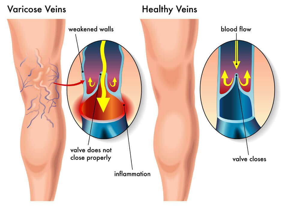 Varicose Vein